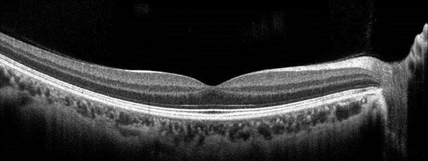 OCT scan available at Chakshu London Opticians